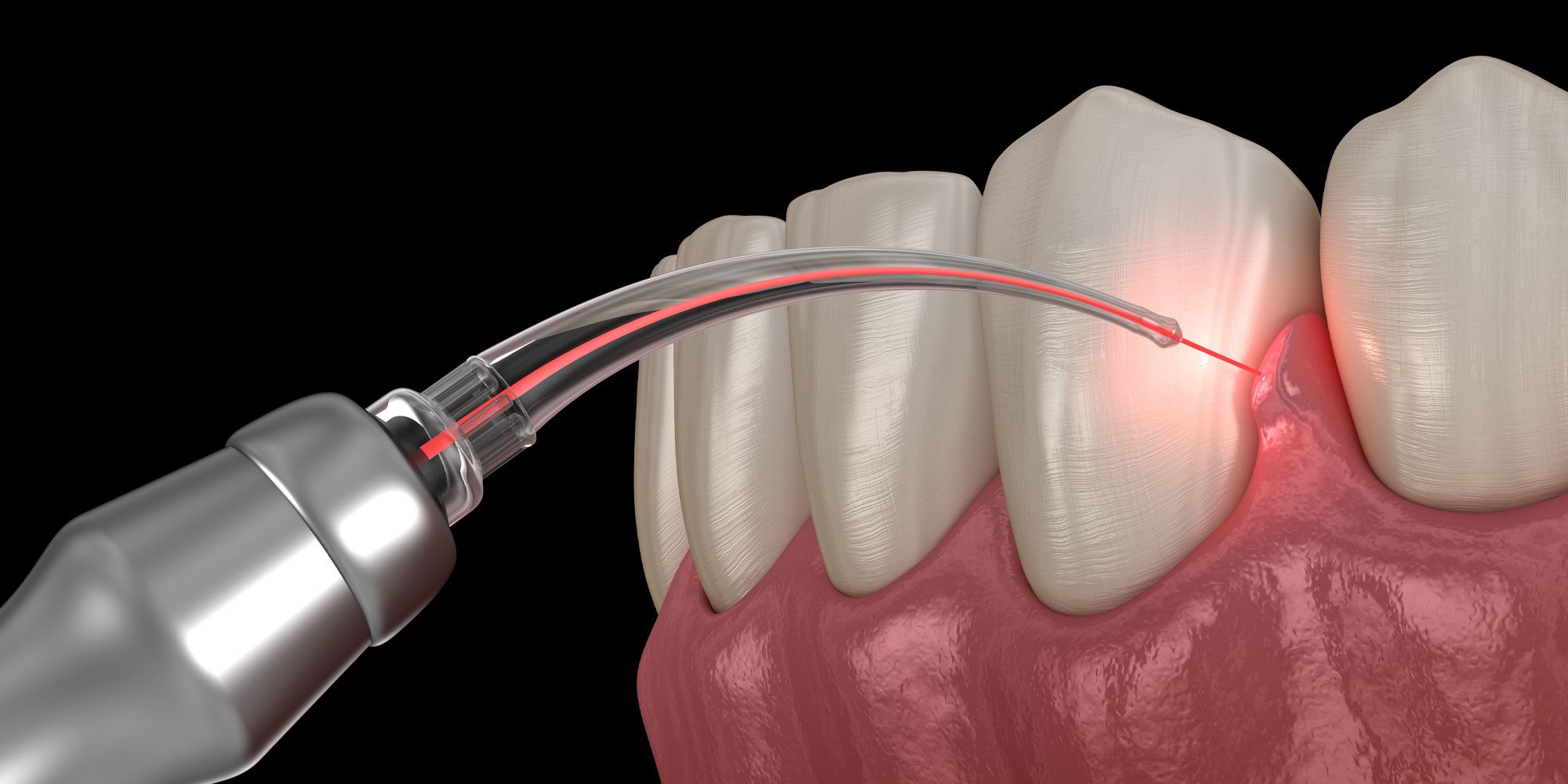 dental laser graphic