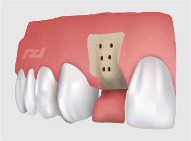 Bone_Grafting-02