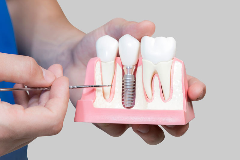 Dental Assistant Showing Off A Dental Implant In A Jawbone Cutaway Model in Springfield, MO