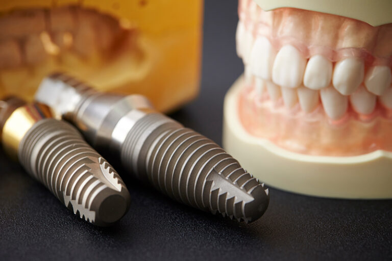 demonstrating the placement of a dental implant on a close up, Ai generated image.