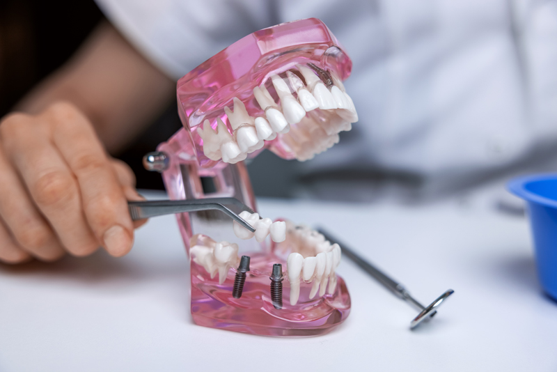 dentist implantologist showing dental bridge implant technology on human tooth jaw model.