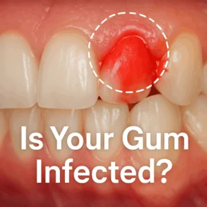 Close up image of gums, with one section highlighted that is inflamed, red, and bleeding. Text on image says: "Is Your Gum Infected?"