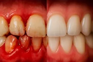 Image of inflamed gums with visible signs of perodental disease, alongside a healthy set of gums for comparison. No text on image.